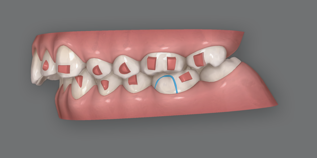 malocclusion